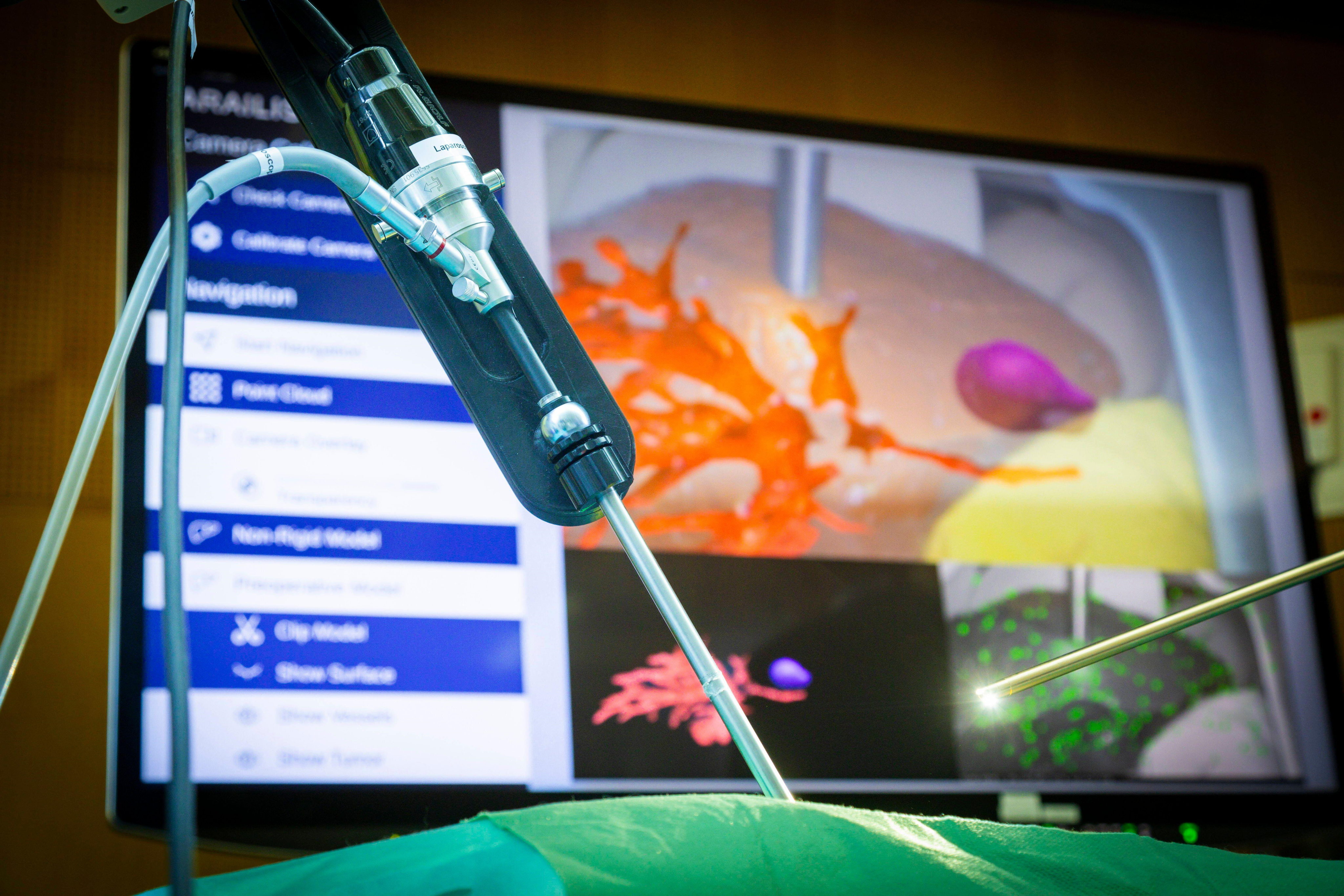 Photo of demonstration of how AI-generated augmented reality images can be used in laparoscopic (keyhole) surgery. Image shows a laporoscope - the instrument that allows surgeons to see inside the body during these procedures - inserted into a model of a human abdomen, with a computer screen behind showing an AI-generated augmented reality image of the inside of the body. Photo taken at Clinical AI Day at Dresden University in April 2024.